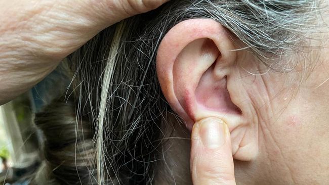 ilustrasi jerawat di telinga 169 - Penyebab Munculnya Jerawat di Telinga
